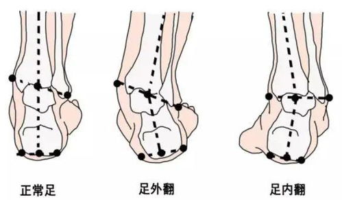 小孩八字脚图片大全，有哪些儿童脚踝畸形图片可以参考？