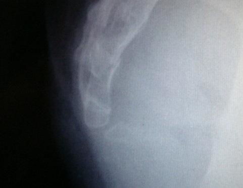 尾骨有疤X光片显示吉凶如何判断？