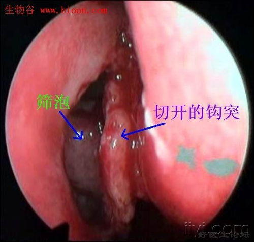 3. 鼻镜检查：黏膜与结构关系的细致评估