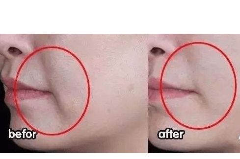 嘴角两边出现八字纹叫什么？括号纹能否消除？