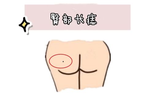 一、 传统方式相面学对臀部痣之解读