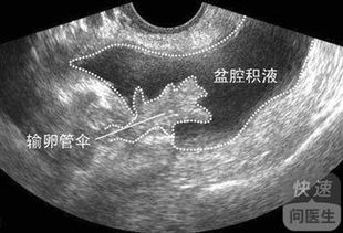 作用于盆腔积液医治的因素