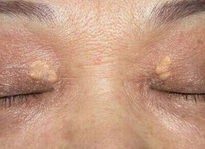 三、 凸起或红紫印堂之吉祥象征