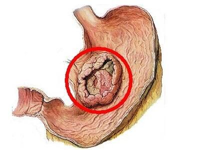 雷莫芦单抗：VEGF信号通路的另一选择