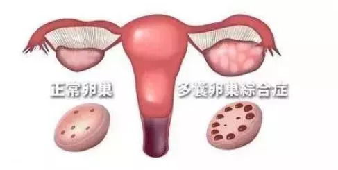 更多囊卵巢综合征（PCOS）
