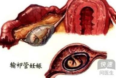 2. 宫外孕真实的像电视剧演的那么可怕吗？