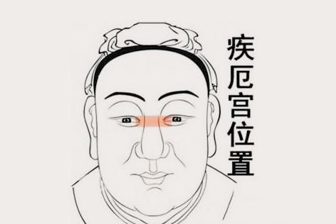 1．左右眼大小不一——右眼较大左眼较小