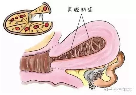 宫腔粘连：作用于怀孕的那一些事儿（保证让你看得眼花缭乱！）