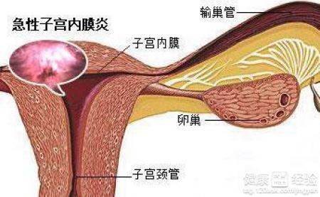6. 子宫内膜炎/盆腔炎：