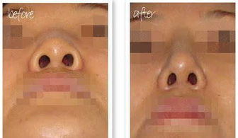 八字形鼻孔有哪些优缺点？