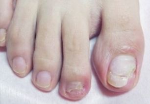 八、  凹凸不平的指甲：健康预警与行事谨慎的信号