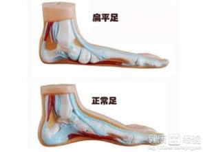 一、 扁平足对男性群体的潜在身体健康状况风险因素解析