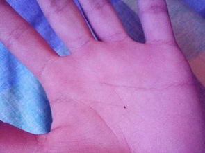 四肢终端（手掌、 脚掌）以及黏膜部位：特殊结构导致高危风险