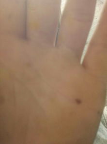 3. 肛门周围痣的特殊性评估