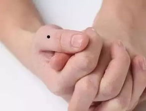 （四）拇指部位痣——家境优渥与成长助力