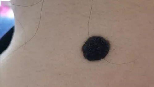 一、  生理机制与流行病学分析：色素痣形成的科学理据