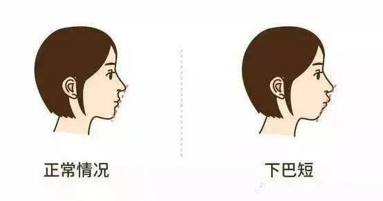 蛇行（波浪）型：深弯曲且呈波浪状
