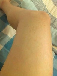 从医学角度审视：足背胎记与潜在健康风险