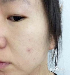 下唇有痣与肠胃健康
