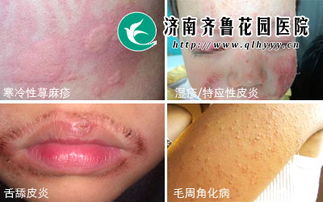 八字土弱的人容易患哪种皮肤病？八字土重的人又容易得什么病？