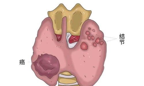 一、 甲状腺癌：木星水行与未申告隐患的交汇