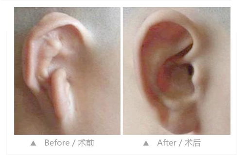 耳廓高低不一之寓意