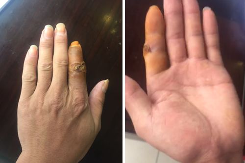 左手食指受伤吉凶预测，男，截一根食指算重伤吗？吉凶如何？