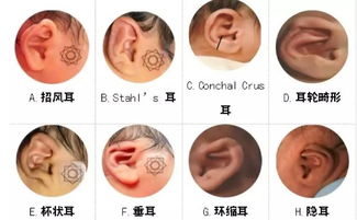 一、 病理定义及解剖学特征