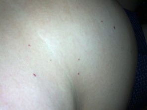 3. 关联疾病及特殊类型