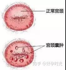 子宫纳囊的成因