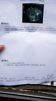 排除宫外孕风险因素