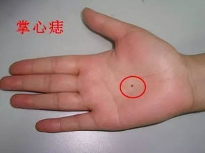 一、  痣相解析的基础理论：位置、色泽与形态的辩证关系