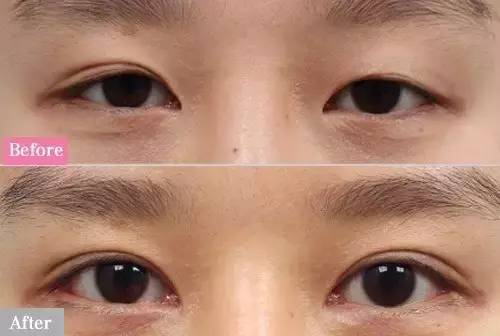 做双眼皮能改变五官风水吗？双眼皮贴零基础学习怎么做？