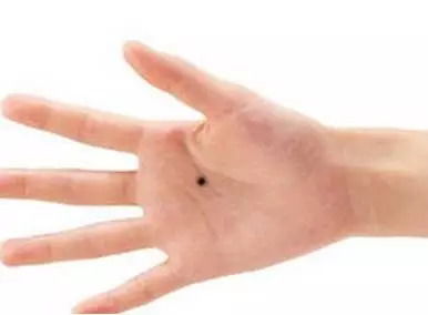 2. 掌心黑痣之象征意义