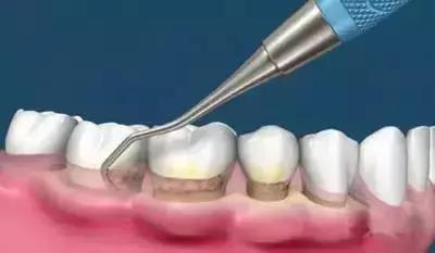 专业洁治技术的临床应用与机制分析