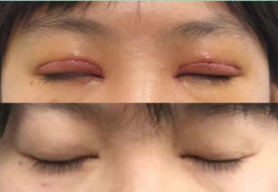 二、 眼部周围疤痕：家庭关系与情感困境