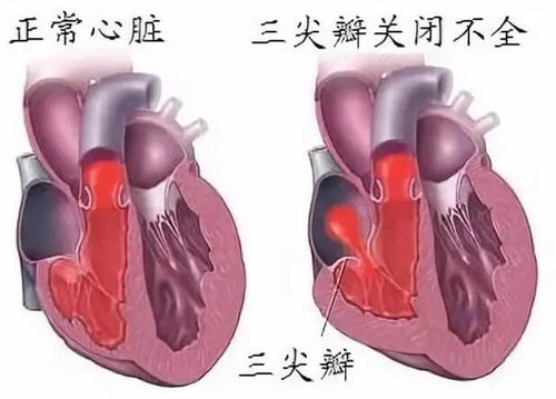 女性群体三尖瓣关闭不全有没有能够生育