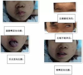 一、  鼻唇沟的解剖学属性与动态演变机理