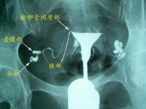 A 超声下子宫输卵管造影（UTS）