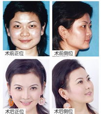 A. 先天性发育畸形：遗传基因的影响