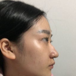 山根处留疤如何通过面相转运改写为长尾？