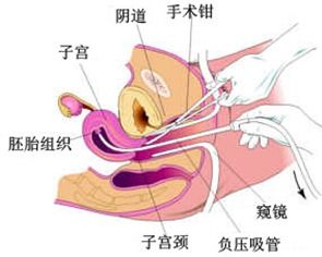 月经较长期不来理疗是关键？
