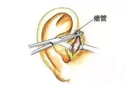耳朵判断幼年时代的状况