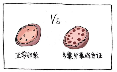 检查卵巢更多囊的最佳时间段