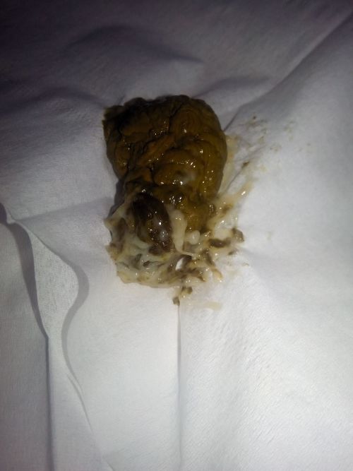 梦见女儿拉出粗大便是什么含义？