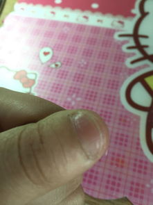 大拇指又短又宽嫩否同过整形手术得到矫正？