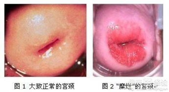 宫颈糜烂的困扰：一个女性群体的痛