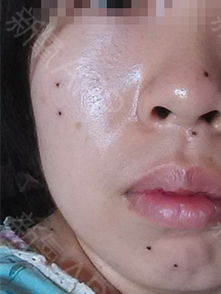 耳朵上的疤痕和痣：少年运势的潜在反映