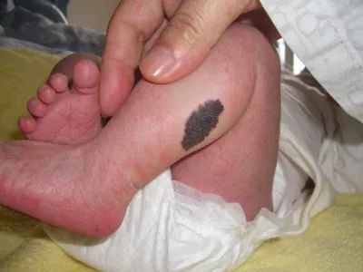 ：胎记的生理存在与命理隐喻的深度解析