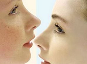 鼻头暗疮：健康受损的警示